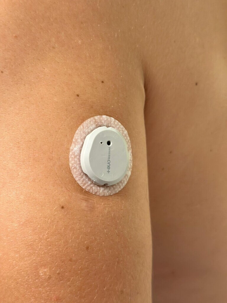 Montare senzor de glicemie Dexcom ONE+